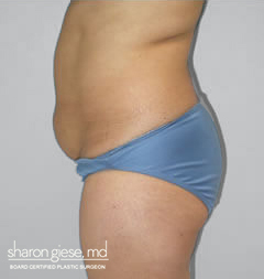 abdominoplasty before picture